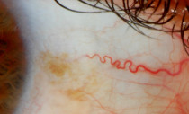 Sclera